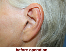 plastic-surgery-prominent-ear 